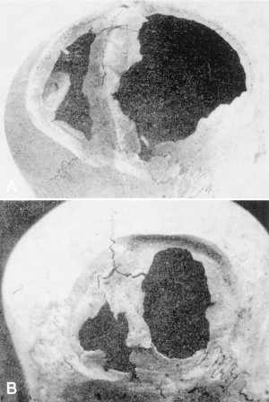 Рисунок 3. A и B – две краниотомии со значительными отверстиями, выполненными посредством выскабливания. Видно, что учтены пути синусов твёрдой мозговой оболочки и сохранены защитные костные перемычки – всё это указывает на анатомическое знание этой области черепа.