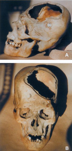 Рисунок 14. A и B, огромные краниотомии со следами костной регенерации.