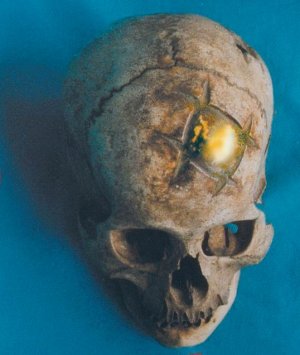 Рисунок 20. Потрясающий череп с впечатляющим результатом фронтальной краниопластики, выполненной с золотой пластиной и последующим идеальным заживлением кости. Небольшую открытую краниотомию видно в левой теменной области.