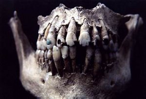Рисунок 5. Зубное украшение методами опиливания и инкрустации: Иштонтон, Гватемала; классический период.