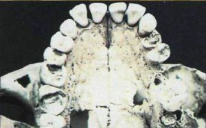 Зубы черепа, относящегося к земледельческому периоду культуры Миссиси­пи. сильно разрушены. Скорее всего на них отрицательно повлияла богатая карбогидратами маисовая диета. Зубы, обнаруженные в селениях доземледельческого периода, более крепкие и обычно лишь покрыты трещинами. Их прочность была обусловлена тем, что пища охотников-собирателей бы­ла более разнообразной.