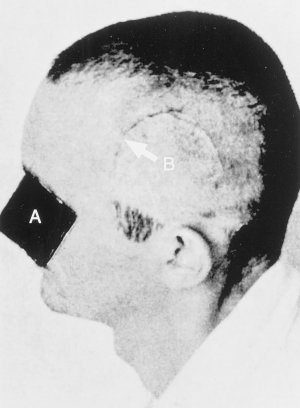 Рисунок 22. Постоперационная фотография Пациента 2 (А), который был прооперирован 1 июля 1953 года Ф. Гранья и Э.Д. Рокка при помощи археологических хирургических инструментов. Была выполнена трепанация для извлечения субдуральной гематомы. B, надрез был выполнен при помощи доинкского tumi (13).