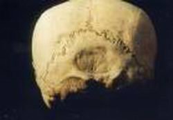 Рис. 5. «Supra-inial повреждение» на затылке черепа с искусственной модификацией из Плайа-дель-Кармен, Кинтана-Роо (Центр INAH на Юкатане).